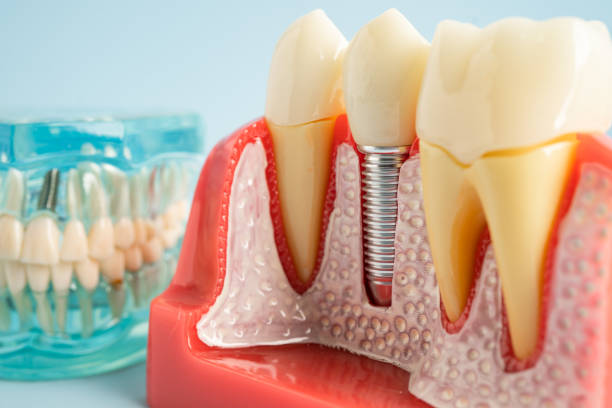 Best Root Canal Treatment  in Lovell, WY